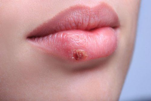 Remedios caseros para el herpes labial
